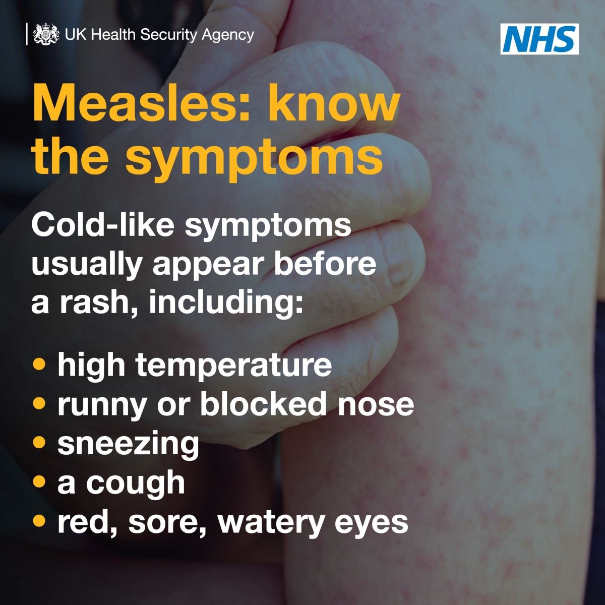 Measles Poster